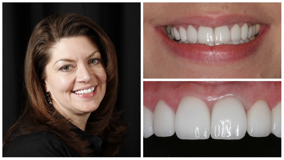 rolling hills dental cosmetic dentist dental implant veneers patient Dr Marty W Lindahl DDS top