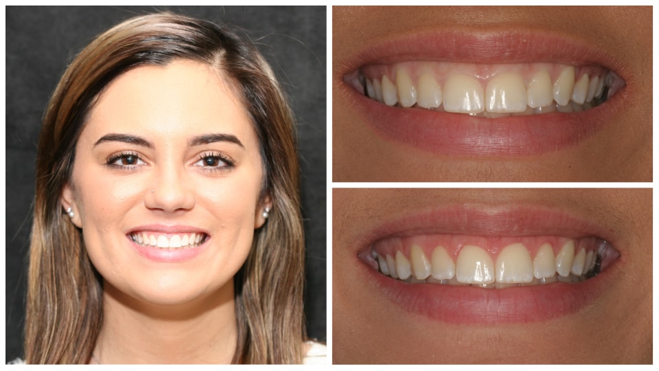 LlanaGumContouringCollage rolling hills dental cosmetic dentist dental implant veneers