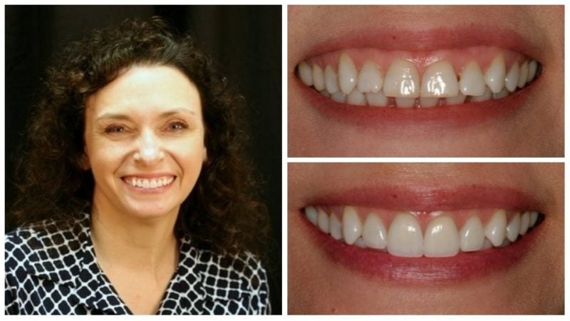 serena's smile transformation