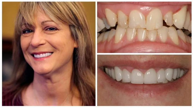 barbara's smile transformation