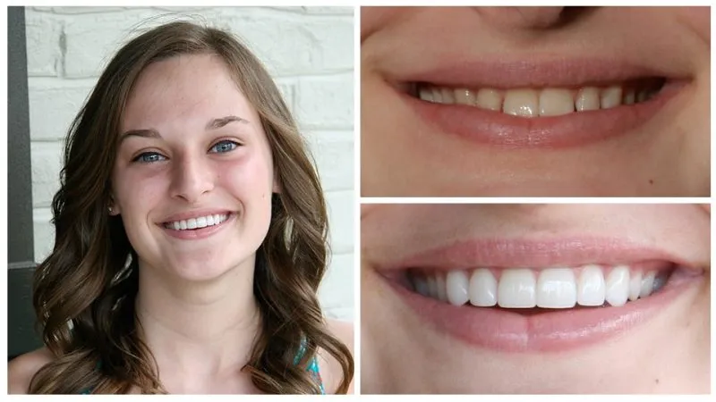 danielle's smile transformation