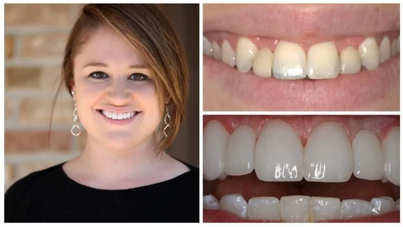 emily's smile transformation
