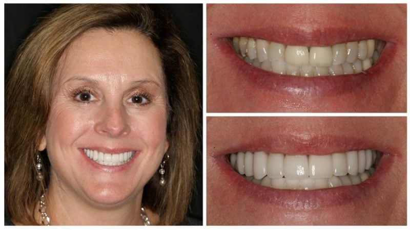 melissa's smile transformation
