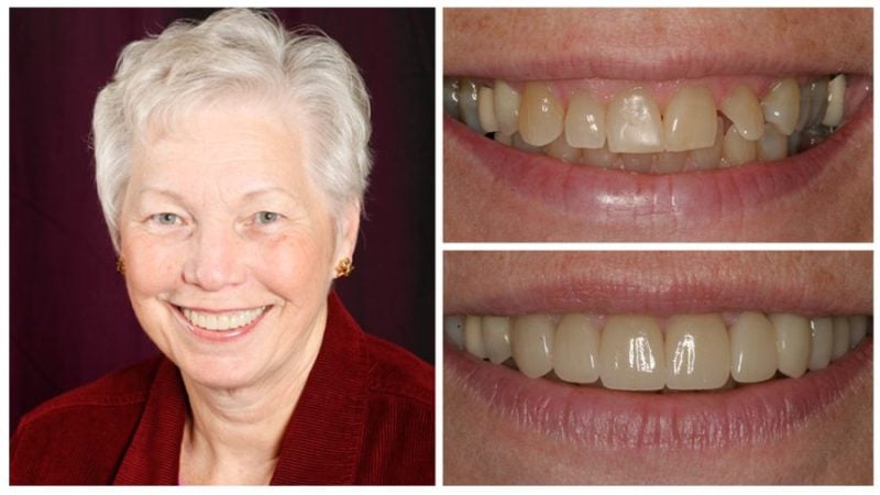 nancy's smile transformation