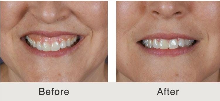 Llana-Gum-Contouring-Collage rolling hills dental cosmetic dentist dental implant veneers patient Dr Marty W Lindahl DDS top rated