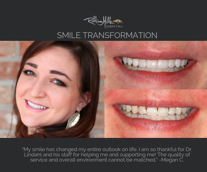 Megan C. Smile Transformation by Dr. Marty W. Lindahl graphic (1)