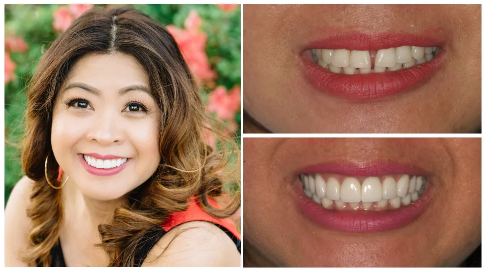 Before and after cosmetic dental treatment
