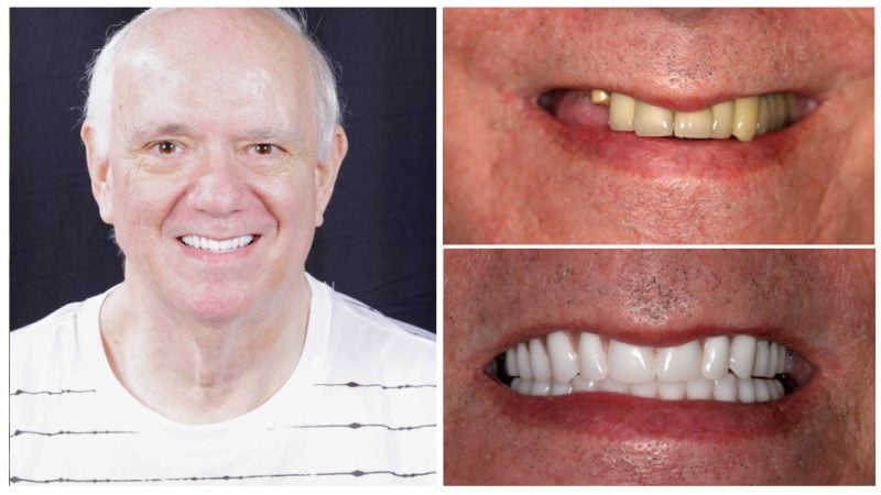 john's smile transformation